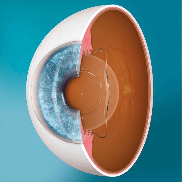 diagram of EVO ICL in eye